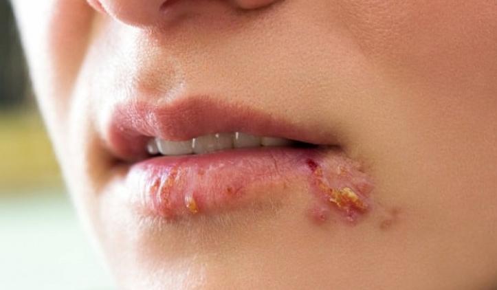 Tại Sao Bị Giời Leo Không Được Nói? Cách Chữa Giời Leo Hiệu Quả
