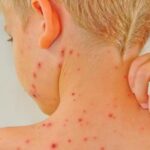 Cách Chữa Bệnh Thủy Đậu Nhanh Nhất