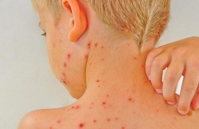 Cách Chữa Bệnh Thủy Đậu Nhanh Nhất: Hướng Dẫn Hiệu Quả và An Toàn Cách Chữa Bệnh Thủy Đậu Nhanh Nhất