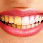 Tại Sao Đánh Răng Thường Xuyên Mà Răng Vẫn Vàng? Nguyên Nhân và Giải Pháp