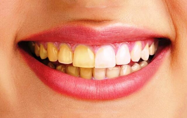 Tại Sao Đánh Răng Thường Xuyên Mà Răng Vẫn Vàng? Nguyên Nhân và Giải Pháp Tại Sao Đánh Răng Thường Xuyên Mà Răng Vẫn Vàng? Nguyên Nhân và Giải Pháp