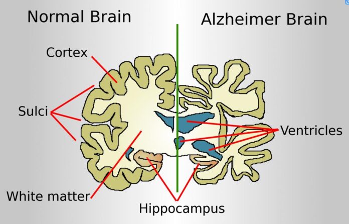 Bệnh Alzheimer (AD) là gì