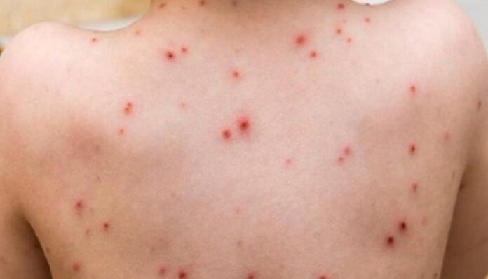 Cách Chữa Đậu Lào Nhanh Nhất