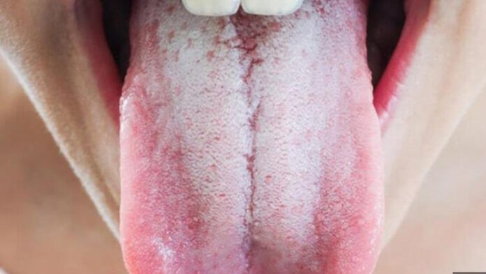 Tại Sao Lưỡi Bị Đóng Bợn Trắng